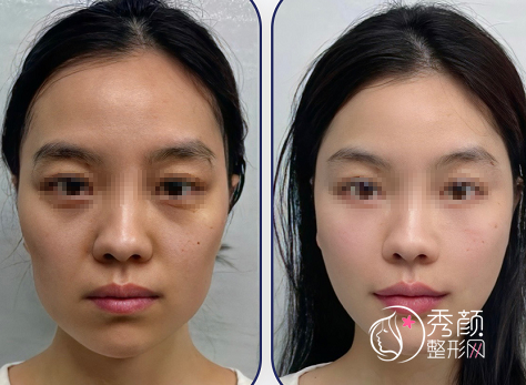 上海联合丽格蒋华吸脂填充怎么样，有没有失败案例？附真实案例