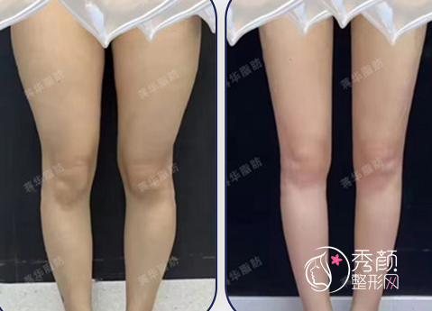 上海联合丽格蒋华吸脂填充怎么样，有没有失败案例？附真实案例