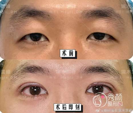 苏州维多利亚苏州端木雪峰坐双眼皮怎么样，有没有失败案例？