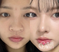 合肥隆鼻医生哪个好？孙洋、朱继锋、张晓龙、赵辑等医生技术分析