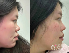 大连隆鼻哪个医院好？爱