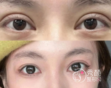 北京双眼皮修复哪个好？靳小雷、张大艳、韩勋、师丽丽、赵红艺等医生