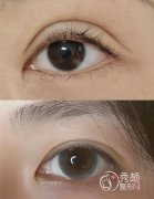 上海双眼皮修复医生哪个