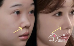 广州隆鼻好的医生名单：