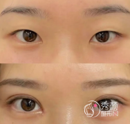 重庆眼部整形哪家医院好？当代、美莱、好美、华美、时光各有特色！