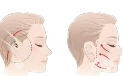 国内做拉皮手术有名的医生：杜太超、赵延勇、谢宏彬、王志坚各有各的实力