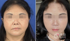 哈尔滨拉皮手术好的医生