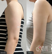 成都抽脂肪正规医院排名：成都八大处、华生铂悦、军大、成都艾米丽等医院上