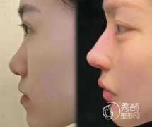 武汉隆鼻医生哪个好？杨