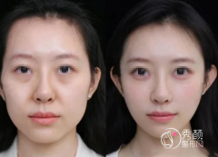 北京全脸脂肪填充张万芳、乔爱军和王自谦哪个医生好？