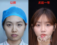 重庆磨骨改脸型哪个医生