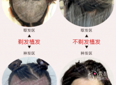 武汉大学中南医院植发怎