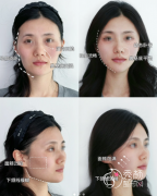 青岛玻尿酸填充哪家好？