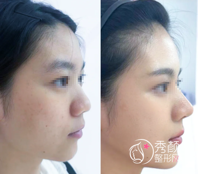 注射隆鼻材料怎么选？宝尼达|濡白天使|伊妍仕少女|玻尿酸干货分享