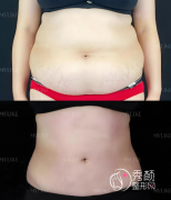 吸脂效果到底是设备重要，还是医生的技术更重要？