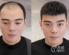 2025年广州植发技术优质医