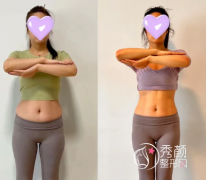 青岛吸脂医院哪家比较好