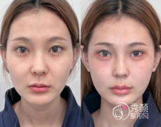 真心建议：大家还是少做点轮廓固定吧……