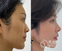 濡白天使隆鼻能维持多久？濡白天使可以溶解吗？常见问题解答！