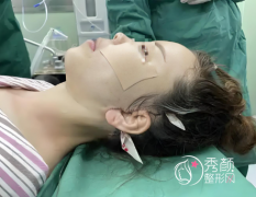 上海九院拉皮手术怎么样