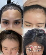 成都植发机构深度测评：