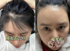 乌鲁木齐植发医院TOP5综合