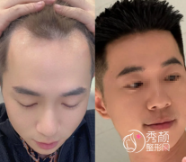 重庆植发哪家医院好？医