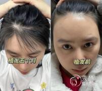 昆明植发哪家医院好？医