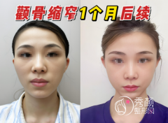 颧骨内推到底适合谁？术前必看干货+选医生避坑指南