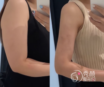 昆明吸脂哪家医院好？昆