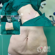 上海腹壁整形医院哪家好