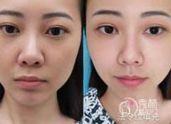 合肥自体脂肪填充技术好