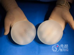 西安假体隆胸哪个医生好