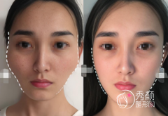 国内磨骨好的医生有柳超