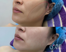 成都面部脂肪填充哪家医