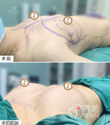 国内自体脂肪隆胸医院排