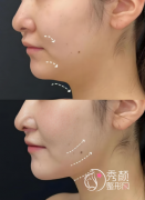 兰州注射垫下巴医院哪家