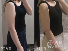 南宁吸脂手术医生排名曝