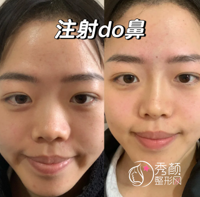上海玻尿酸注射隆鼻哪家医院好？联合丽格|艺星|薇琳|伊莱美等都不错