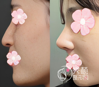 大连隆鼻哪个医生好？大连隆鼻技术好的医生名单曝光！