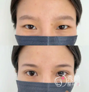 盘点广州双眼皮|双眼皮修