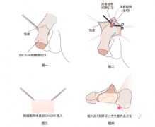 重庆男科生殖延长手术哪