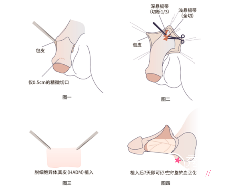 重庆男科生殖延长手术哪个医院好？这几家医院做男性生殖器整形技术好！