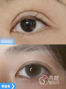 国内十大双眼皮修复医生