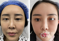 北京拉皮做得好的医生：