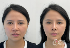 福建自体脂肪填充医院排