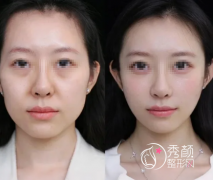 天津注射玻尿酸哪里好？