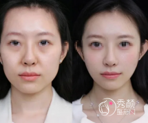 北京玻尿酸注射医生排名