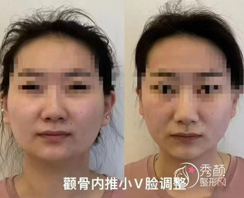 重庆颧骨内推哪个医生好？肖林、朱乐林等重庆颧骨内推医生深度分析