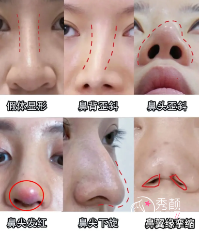 福州隆鼻失败修复医院哪家好？美贝尔|海峡|格莱美等医院优势大！